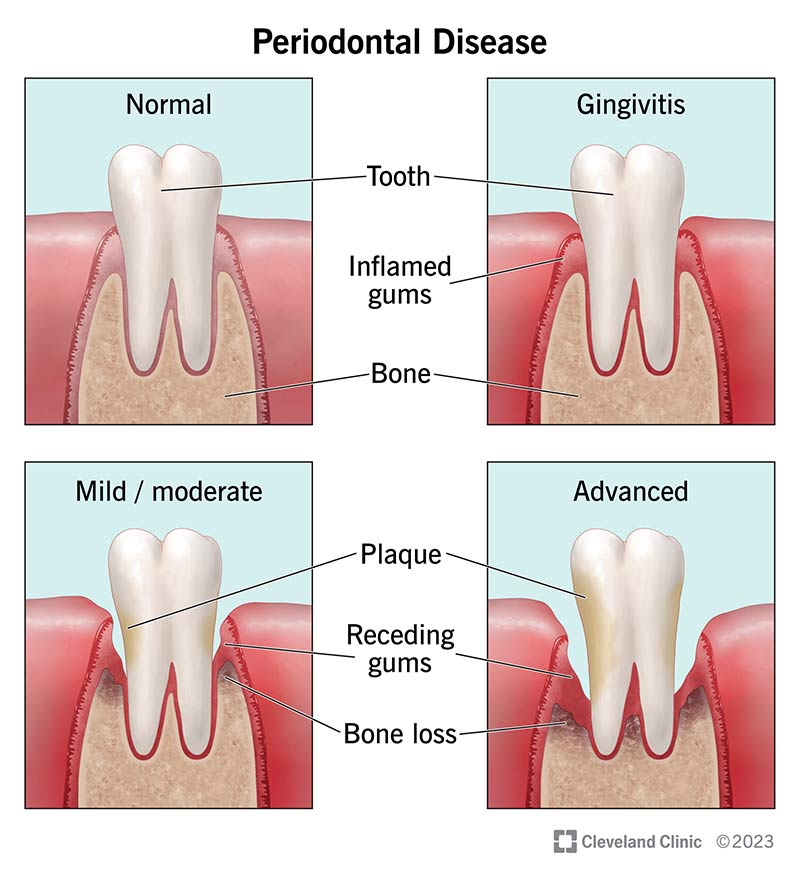 diagram of normal and unhealthy gums